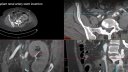 Renal Transplant Arterial Tsunami Stent